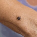 czerniak profilaktyka