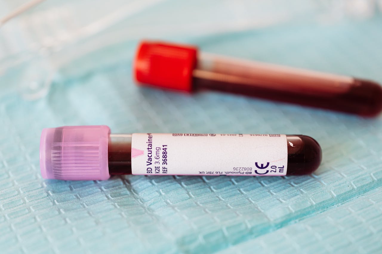 Nadpłytkowość samoistna – objawy, diagnostyka i leczenie
